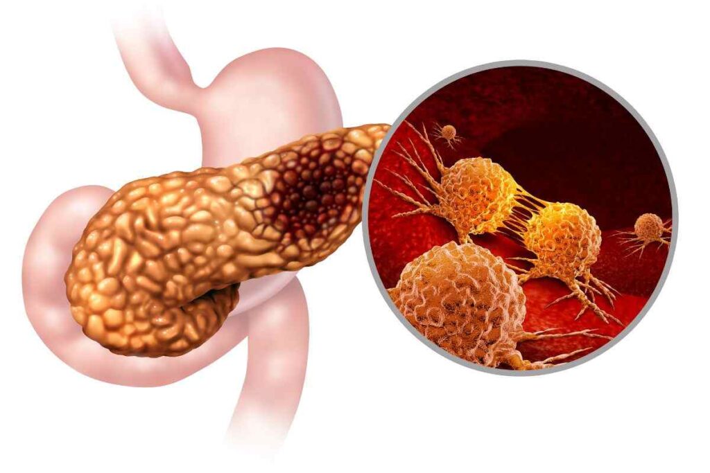 Cancro al pancreas come prevenirlo